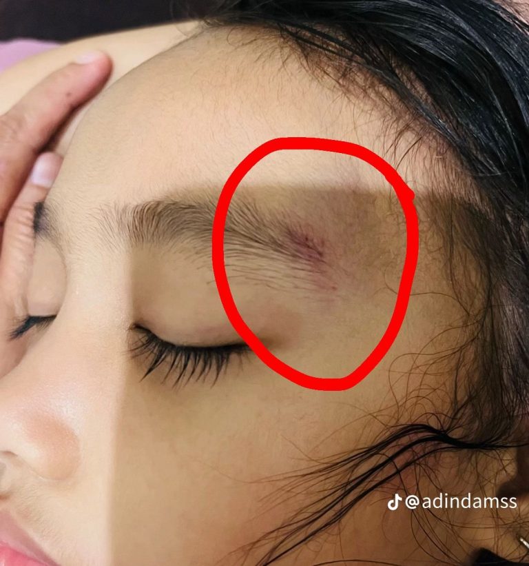 Diduga Tolak Pasien, Petugas Puskesmas Camplong Asyik Makan Rujak Saat Anak Luka Butuh Pertolongan Diduga Tolak Pasien, Petugas Puskesmas Camplong Asyik Makan Rujak Saat Anak Luka Butuh Pertolongan